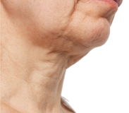 Decades shown by loose skin below the chin